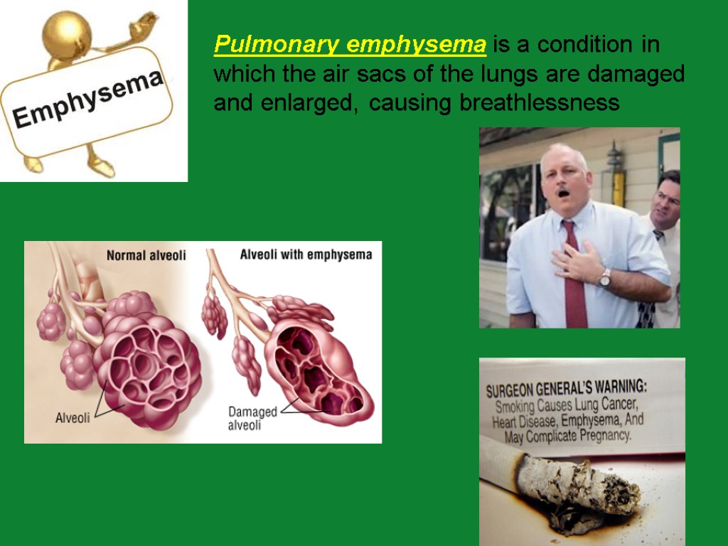 Pulmonary emphysema is a condition in which the air sacs of the lungs are